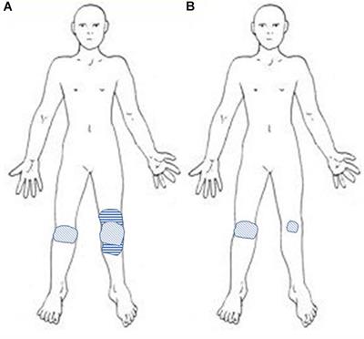 The Value of High-Frequency Repetitive Transcranial Magnetic Stimulation of the Motor Cortex to Treat Central Pain Sensitization Associated With Knee Osteoarthritis